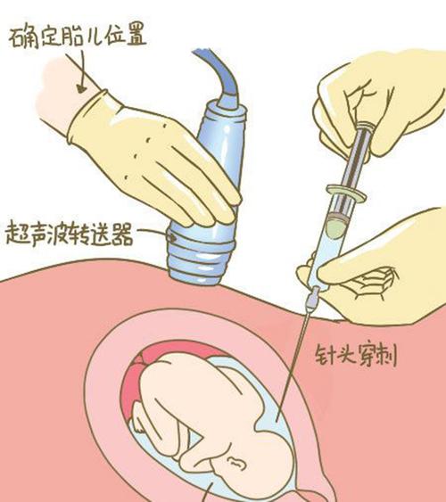 绍兴羊水孕期亲子鉴定